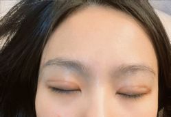 体验后-紫洁俪方（北京）医疗美容