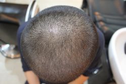 点击看大图 -大麦微针植发丨全国连锁