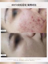 体验后-skin79皮肤管理中心