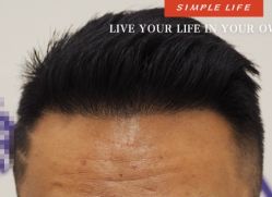 -大麦微针植发全国连锁