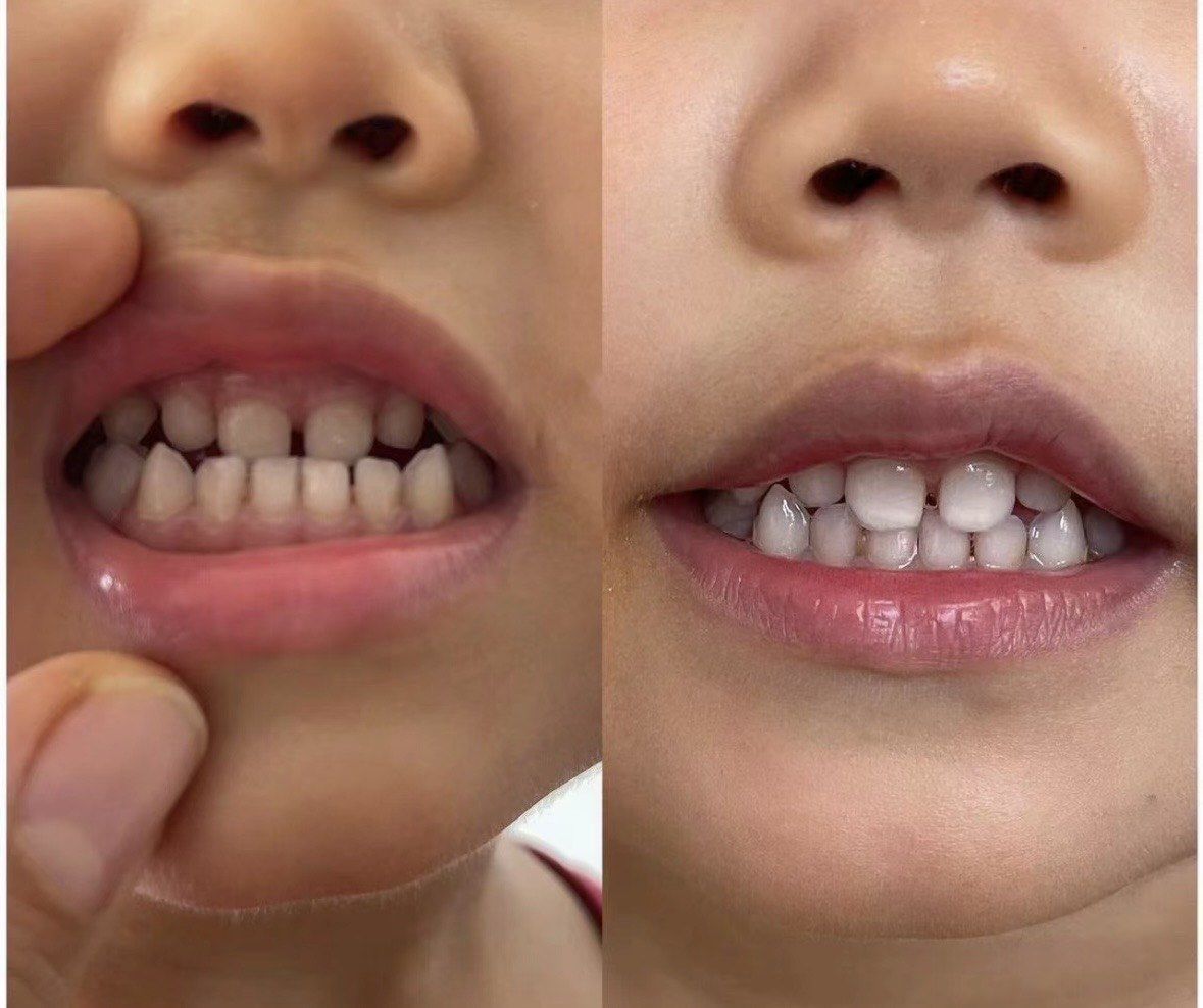 小宝贝的地包天矫正之旅