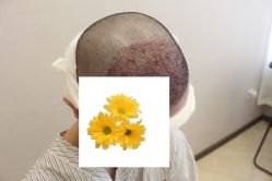 -大麦微针植发丨全国连锁