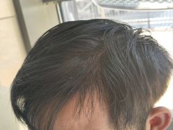 -碧莲盛·不剃发植发