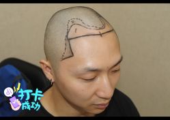 -大麦微针植发全国连锁