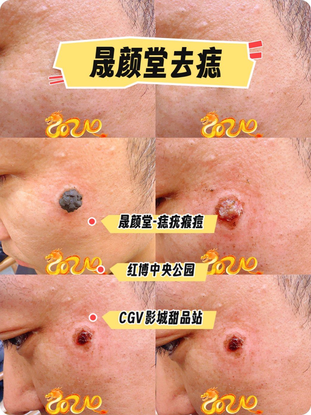 去掉疣疣更美丽