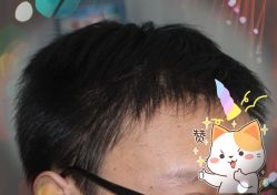 -大麦微针植发全国连锁