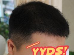 -大麦微针植发丨全国连锁