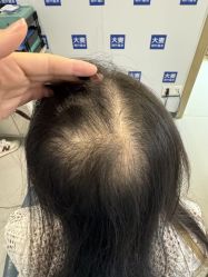 -大麦微针植发全国连锁
