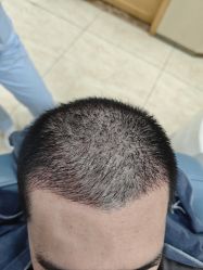 -大麦微针植发全国连锁