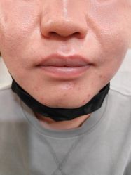 体验后-北京美痣堂古方祛痣斑疣瘊