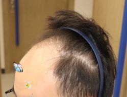 -大麦微针植发全国连锁