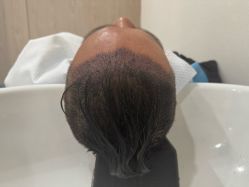 -大麦微针植发全国连锁