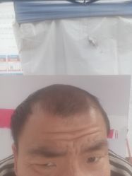 -碧莲盛·不剃发植发