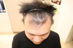 -大麦微针植发丨全国连锁