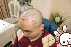 点击看大图 -大麦微针植发丨全国连锁