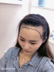 -大麦微针植发丨全国连锁