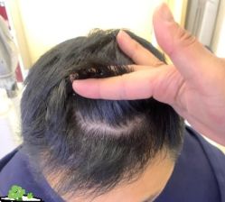 -大麦微针植发丨全国连锁