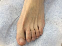 -德哥灰指甲脚气甲沟炎跖疣护理