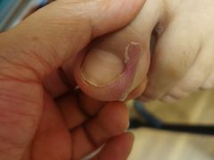 -世龙世家灰指甲鸡眼脚气甲沟炎跖疣护理(通州店)