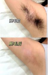 -薇兰专业脱毛连锁机构