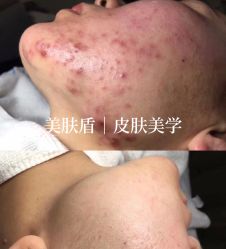点击看大图 -美肤盾祛痘·问题肌头疗管理中心