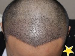 -大麦微针植发丨全国连锁