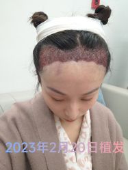 体验后-大麦微针植发丨全国连锁