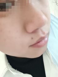 体验后-清疣美疣·痣·斑净肤中心