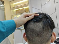 -碧莲盛·不剃发植发