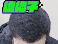 -大麦微针植发丨全国连锁