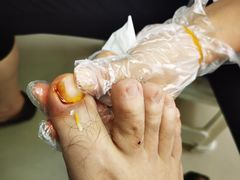 -世龙世家甲沟炎·灰指甲·嵌甲矫正·修脚(武侯区双楠店)