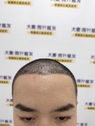 -大麦微针植发全国连锁