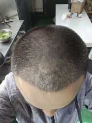 -大麦微针植发丨全国连锁