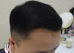 -大麦微针植发丨全国连锁