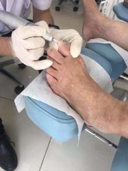 -派恩宜灰指甲鸡眼嵌甲手足癣