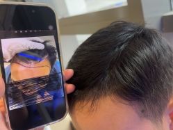 -碧莲盛·不剃发植发