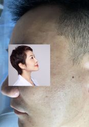 -爱莎扁平疣·汗管瘤·斑痣中心