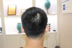 -大麦微针植发丨全国连锁