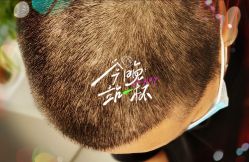 -大麦微针植发全国连锁