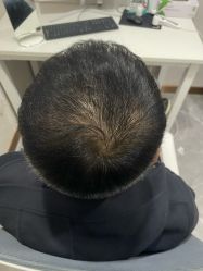 -碧莲盛·不剃发植发