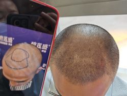 -碧莲盛·不剃发植发