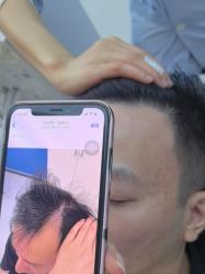 -大麦微针植发全国连锁