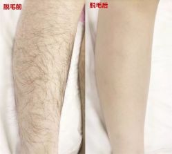 -薇兰专业脱毛连锁机构