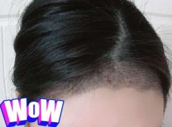 -大麦微针植发丨全国连锁