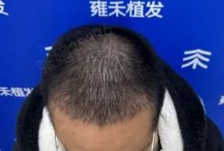 -雍禾植发全国连锁