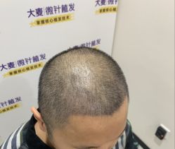 -大麦微针植发全国连锁