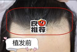 -大麦微针植发全国连锁