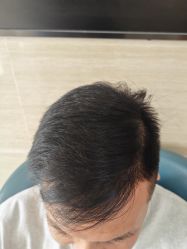 -大麦微针植发丨全国连锁