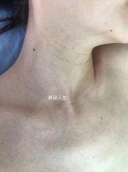 -爱莎扁平疣·汗管瘤·斑痣中心