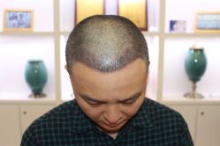 点击看大图 -大麦微针植发丨全国连锁